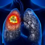 lung cancer